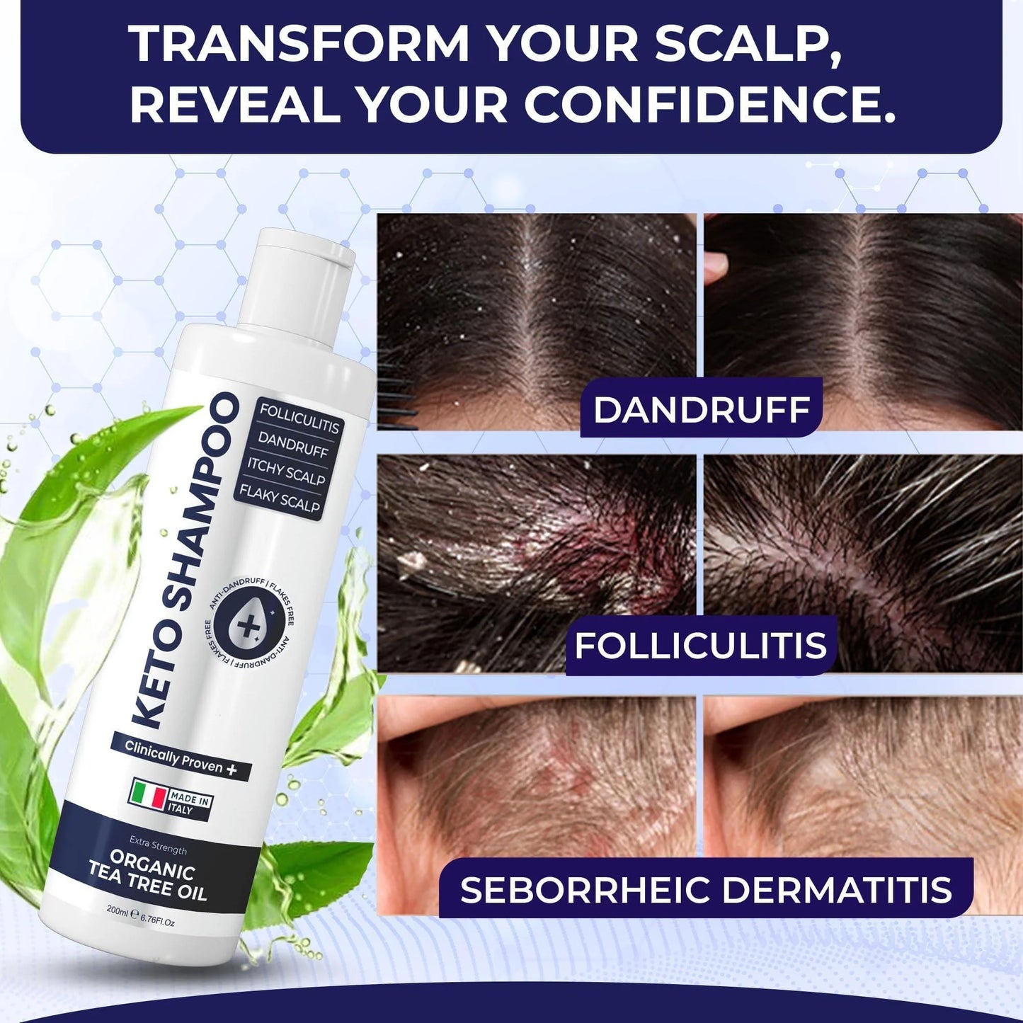 Scalp Psoriasis Shampoo Flakes anti Dandruff Itchy Scalp Treatment for Seborrheic Dermatitis & Folliculitis anti Fungal Medicated Solution for Itchy Flaky & Dry Hairs